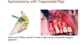 Apicoectomy with Trapezoidal Flap
Placement of filling material in cavity of apex using miniaturized amalgam
applicator.
 