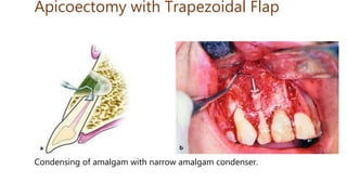 Apicoectomy with Trapezoidal Flap
Condensing of amalgam with narrow amalgam condenser.
 