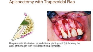 Apicoectomy with Trapezoidal Flap
Diagrammatic illustration (a) and clinical photograph (b) showing the
apex of the tooth with retrograde filling complete.
 