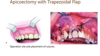 Apicoectomy with Trapezoidal Flap
Operation site and placement of sutures.
 