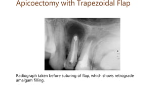 Apicoectomy with Trapezoidal Flap
Radiograph taken before suturing of flap, which shows retrograde
amalgam filling.
 