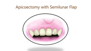 Apicoectomy with Semilunar Flap
 
