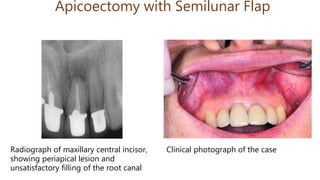 Apicoectomy with Semilunar Flap
Radiograph of maxillary central incisor,
showing periapical lesion and
unsatisfactory filling of the root canal
Clinical photograph of the case
 