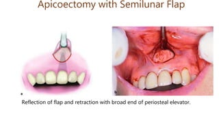 Apicoectomy with Semilunar Flap
Reflection of flap and retraction with broad end of periosteal elevator.
 