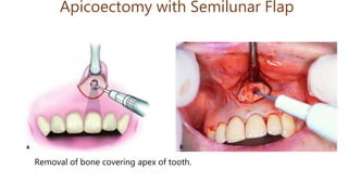 Apicoectomy with Semilunar Flap
Removal of bone covering apex of tooth.
 