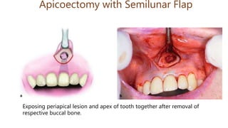 Apicoectomy with Semilunar Flap
Exposing periapical lesion and apex of tooth together after removal of
respective buccal bone.
 