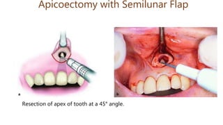 Apicoectomy with Semilunar Flap
Resection of apex of tooth at a 45° angle.
 