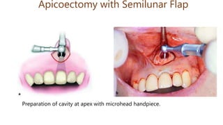 Apicoectomy with Semilunar Flap
Preparation of cavity at apex with microhead handpiece.
 