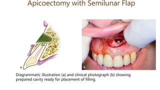Apicoectomy with Semilunar Flap
Diagrammatic illustration (a) and clinical photograph (b) showing
prepared cavity ready for placement of filling.
 