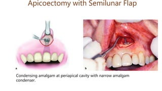 Apicoectomy with Semilunar Flap
Condensing amalgam at periapical cavity with narrow amalgam
condenser.
 