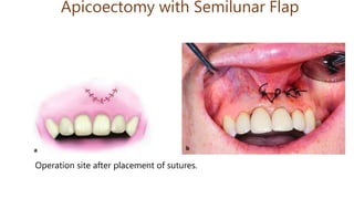 Apicoectomy with Semilunar Flap
Operation site after placement of sutures.
 