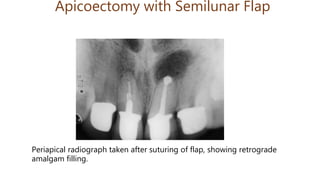 Apicoectomy with Semilunar Flap
Periapical radiograph taken after suturing of flap, showing retrograde
amalgam filling.
 