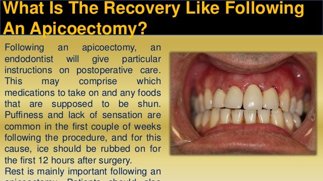Apicoectomy A Surgical Option When Root Canal Treatment Fails