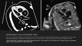 A pictorial guide for the 2nd Trimester USG | PPTX