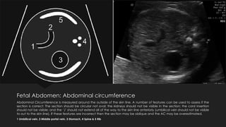 A pictorial guide for the 2nd Trimester USG | PPTX