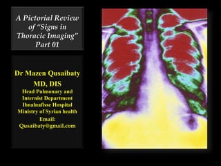 A Pictorial Review
of “Signs in
Thoracic Imaging”
Part 01
Dr Mazen Qusaibaty
MD, DIS
Head Pulmonary and
Internist Department
Ibnalnafisse Hospital
Ministry of Syrian health
Email:
Qusaibaty@gmail.com
 