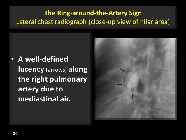 a pictorial review of signs in thoracic imaging 02