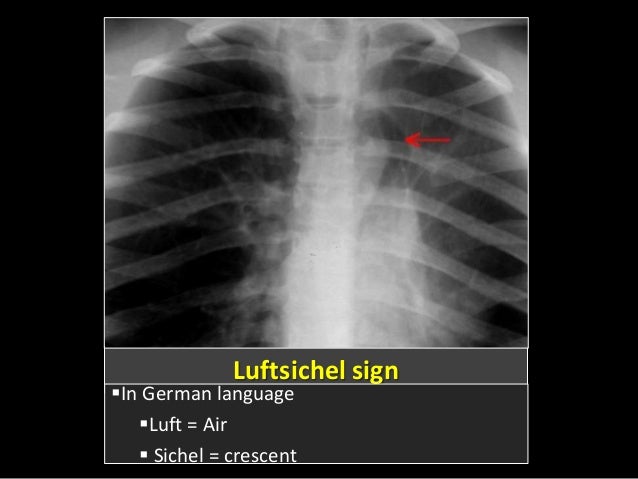 Luftcycle Sign Luftsichel Bedeutung , Luftsichel sign (lungs) – SRXQ