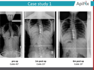 6m post op1m post oppre op
Case study 1
Cobb 45ο Cobb 23ο Cobb 19ο
 