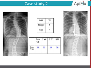 Case study 2
Pre-
Op
2 W 6 W 3 M
Cobb
Angle
53 30 26 26
Age 13
Risser 1
Sex F
 