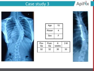 Case study 3
Pre-
Op
Post-
Op
6
weeks
3 M
52 32 30 30
Age 15
Risser 4
Sex F
 