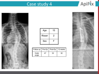 Follow up Pre-Op Post-Op 12 weeks
Cobb
angle
47 33 30
Case study 4
Age 15
Risser 2
Sex F
 