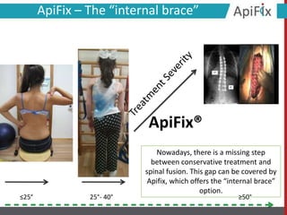 Nowadays, there is a missing step
between conservative treatment and
spinal fusion. This gap can be covered by
Apifix, which offers the “internal brace”
option.
25°- 40°≤25° ≥50°
ApiFix – The “internal brace”
ApiFix®
 