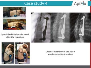 Case study 4
Spinal flexibility is maintained
after the operation
Gradual expansion of the ApiFix
mechanism after exercises
 