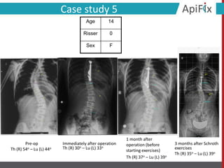 Pre-op
Th (R) 54ο – Lu (L) 44ο
Immediately after operation
Th (R) 30ο – Lu (L) 33ο
1 month after
operation (before
starting exercises)
Th (R) 37ο – Lu (L) 39ο
3 months after Schroth
exercises
Th (R) 35ο – Lu (L) 39ο
Case study 5
Age 14
Risser 0
Sex F
 