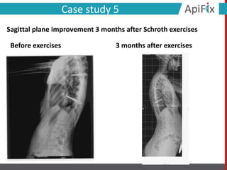 Before exercises 3 months after exercises
Case study 5
Sagittal plane improvement 3 months after Schroth exercises
 