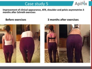 Before exercises 3 months after exercises
Case study 5
Improvement of clinical appearance, ATR, shoulder and pelvic asymmetries 3
months after Schroth exercises
 