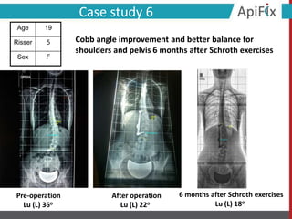 Pre-operation
Lu (L) 36ο
After operation
Lu (L) 22ο
Case study 6
6 months after Schroth exercises
Lu (L) 18ο
Age 19
Risser 5
Sex F
Cobb angle improvement and better balance for
shoulders and pelvis 6 months after Schroth exercises
 