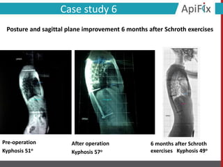 Pre-operation
Kyphosis 51ο
After operation
Kyphosis 57ο
Case study 6
6 months after Schroth
exercises Kyphosis 49ο
Posture and sagittal plane improvement 6 months after Schroth exercises
 