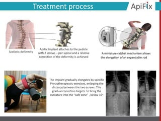Treatment process
Scoliotic deformity
ApiFix Implant attaches to the pedicle
with 2 screws – peri apical and a relative
correction of the deformity is achieved
A miniature ratchet mechanism allows
the elongation of an expandable rod
The implant gradually elongates by specific
Physiotherapeutic exercises, enlarging the
distance between the two screws. This
gradual correction targets to bring the
curvature into the “safe zone” , below 35ο
 