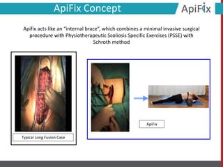 ApiFix
Typical Long Fusion Case
ApiFix Concept
Apifix acts like an “internal brace”, which combines a minimal invasive surgical
procedure with Physiotherapeutic Scoliosis Specific Exercises (PSSE) with
Schroth method
 