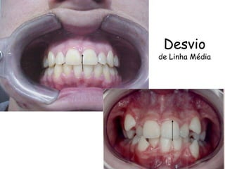 Desvio de Linha Média