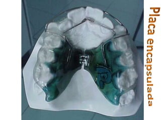 Aparelho sup.Placa encapsulada