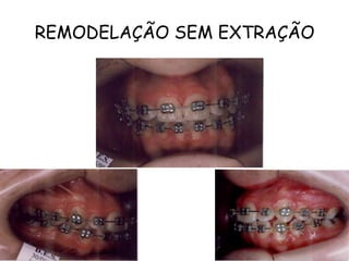 REMODELAÇÃO SEM EXTRAÇÃO