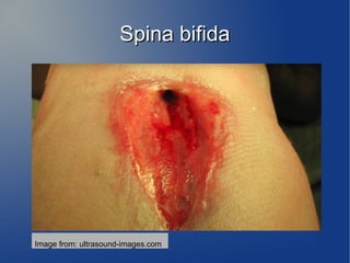 SSppiinnaa bbiiffiiddaa 
Image from: ultrasound-images.com 
 
