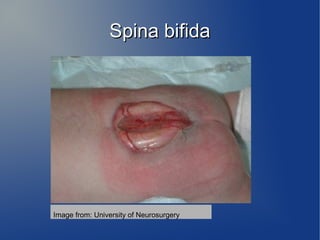 SSppiinnaa bbiiffiiddaa 
Image from: University of Neurosurgery 
 