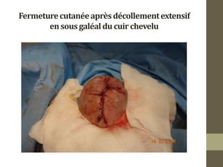 Fermeturecutanéeaprèsdécollementextensif
ensousgaléaldu cuirchevelu
 