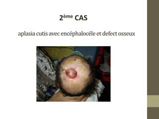 aplasiacutisavec encéphalocéleetdefectosseux
2ème CAS
 