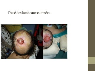 Tracédeslambeauxcutanées
 