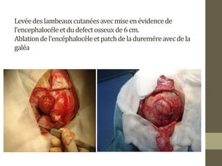 Levéedeslambeauxcutanéesavecmiseenévidencede
l’encephalocéleetdudefectosseuxde6cm.
Ablationdel’encéphalocèleetpatchdeladureméreavecdela
galéa
 