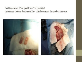 Prélèvementd’ungreffond’ospariétal
quenousavonsfenduen2etcomblementdudefectosseux
 