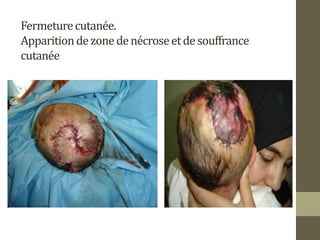 Fermeturecutanée.
Apparitiondezonedenécroseetdesouffrance
cutanée
 