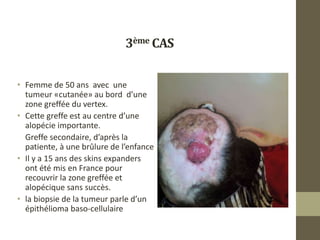 3ème CAS
• Femme de 50 ans avec une
tumeur «cutanée» au bord d’une
zone greffée du vertex.
• Cette greffe est au centre d’une
alopécie importante.
Greffe secondaire, d’après la
patiente, à une brûlure de l’enfance
• Il y a 15 ans des skins expanders
ont été mis en France pour
recouvrir la zone greffée et
alopécique sans succès.
• la biopsie de la tumeur parle d’un
épithélioma baso-cellulaire
 