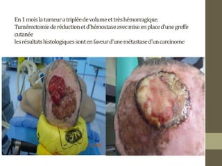 En1moislatumeuratripléedevolumeettrèshémorragique.
Tumérectomiederéductionetd’hémostaseavecmiseenplaced’unegreffe
cutanée
lesrésultatshistologiquessontenfaveurd’unemétastased’uncarcinome
 