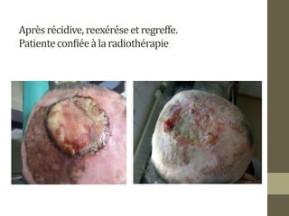 Aprèsrécidive,reexéréseetregreffe.
Patienteconfiéeàlaradiothérapie
 