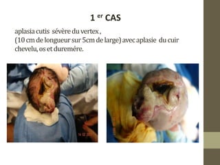 aplasiacutis sévèreduvertex,
(10cmdelongueursur5cmdelarge)avecaplasie ducuir
chevelu,osetduremére.
1 er CAS
 